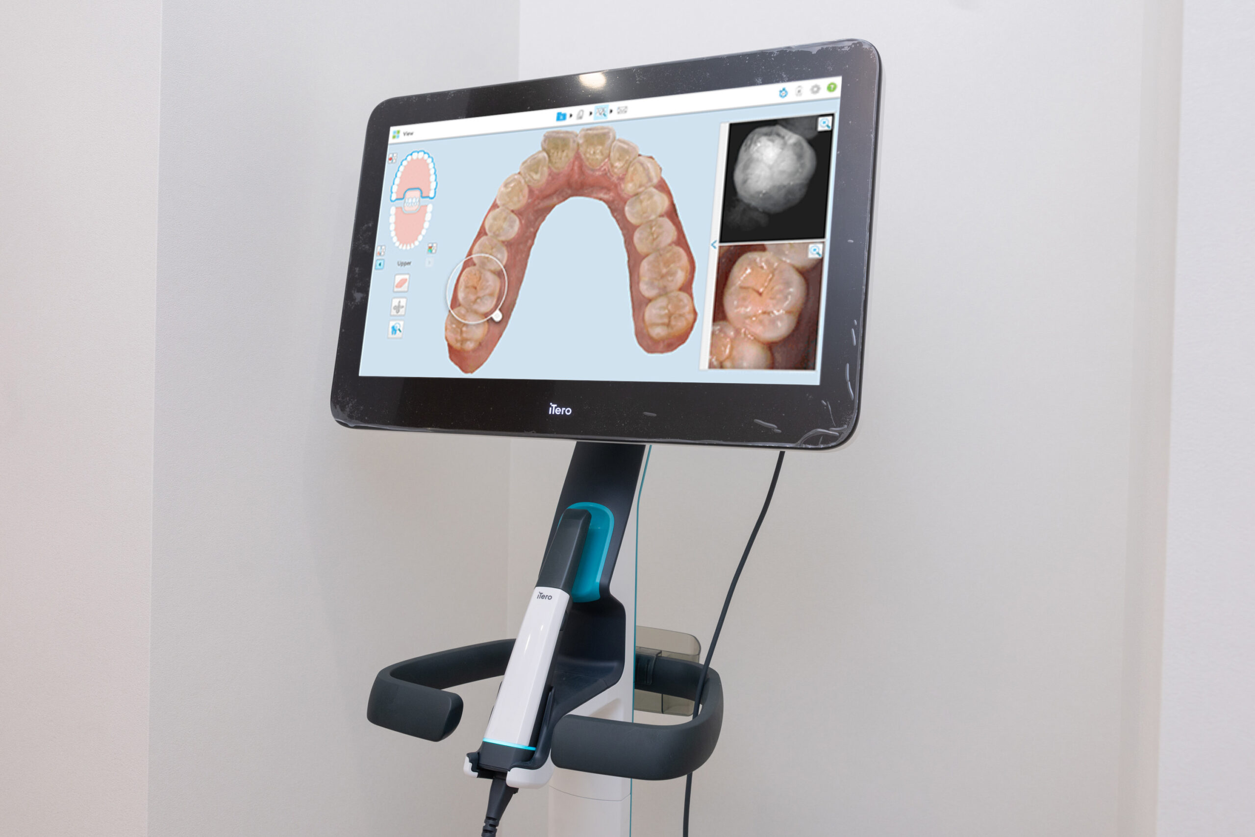 口腔内スキャナー(iTero)
